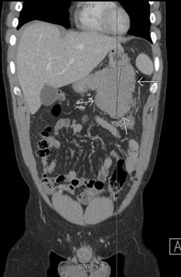Case report: Desmoid fibromatosis diagnosed in a 27-year-old male after being mistaken for a gastrointestinal stromal tumour